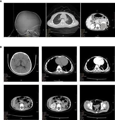 Clinical and Molecular Differentiation Between Malignant Rhabdoid Tumor of the Kidney and Normal Tissue: A Two-Case Report